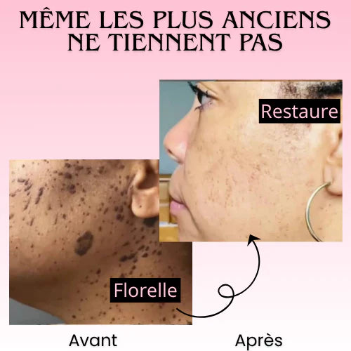 Florelle Anti Verrues