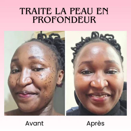 Florelle Anti Verrues