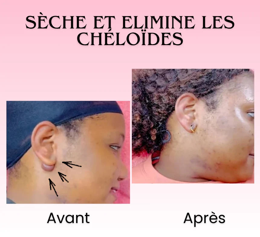 Florelle Anti cicatrices